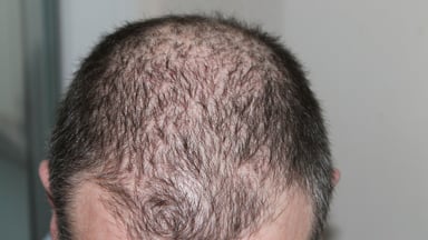 Hair today, gone tomorrow: Minoxidil drug sellers hit by MHRA