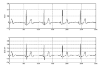Figure 4. This graph compares CCNE difference signals with those generated using contact ECG electrodes. 