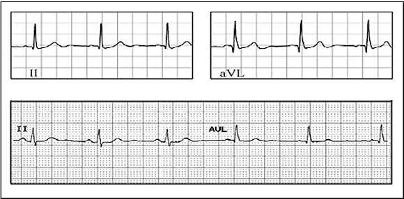 Figure 5. ECG readouts showing the results using EPIC (top) vs. traditional wet electrode ECG (bottom)
