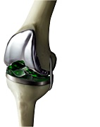 The OrthoSensor VeraSense Total Knee Alignment system