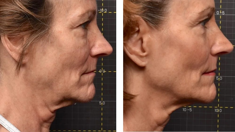Woman before and after Sofwave treatment