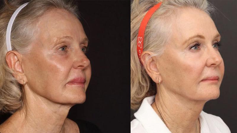 Texas woman before and after Sofwave treatment