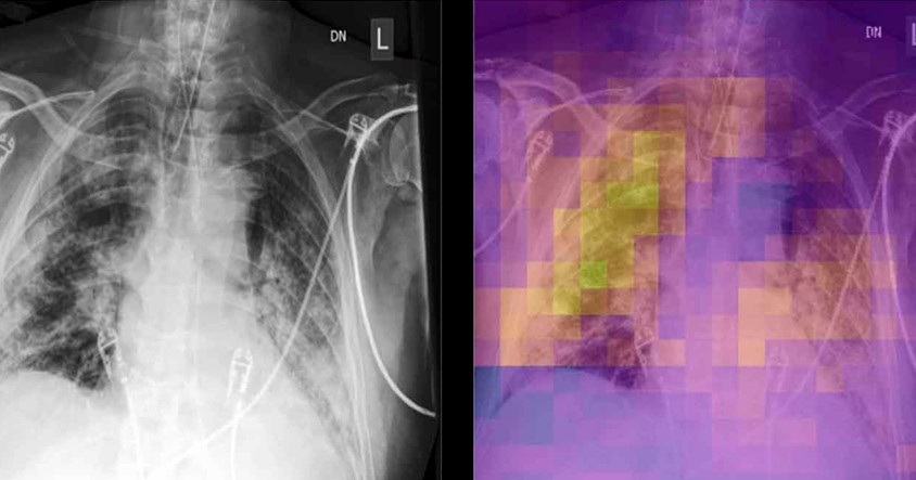 AI scans chest X-rays for covid