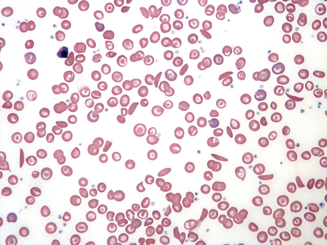 sickle cell anemia 