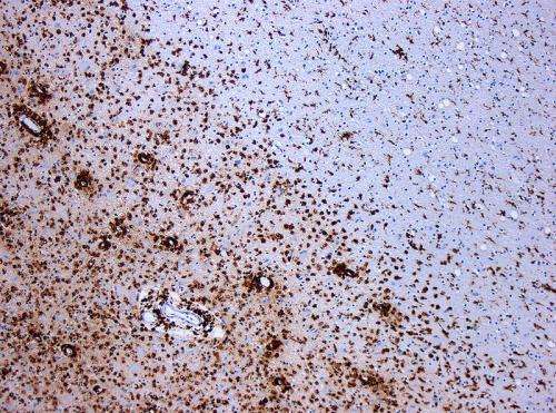 Demyelination by MS The CD68 colored tissue shows several macrophages in the area of the lesion Original scale 1100