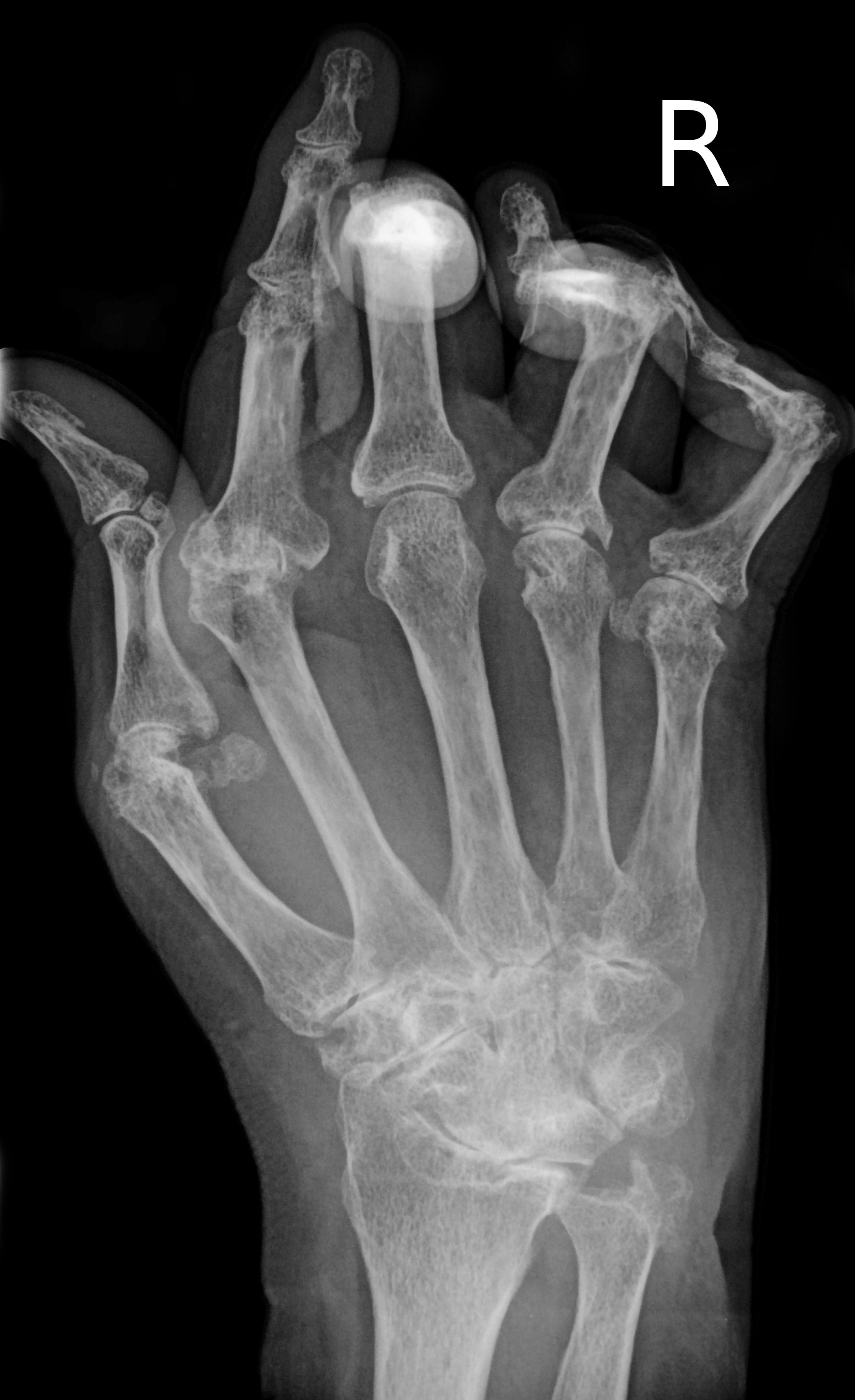 X-ray of the hand in rheumatoid arthritis