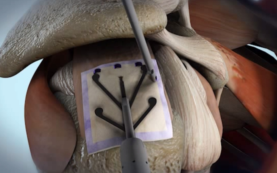 An animation of the rotator cuff system being used
