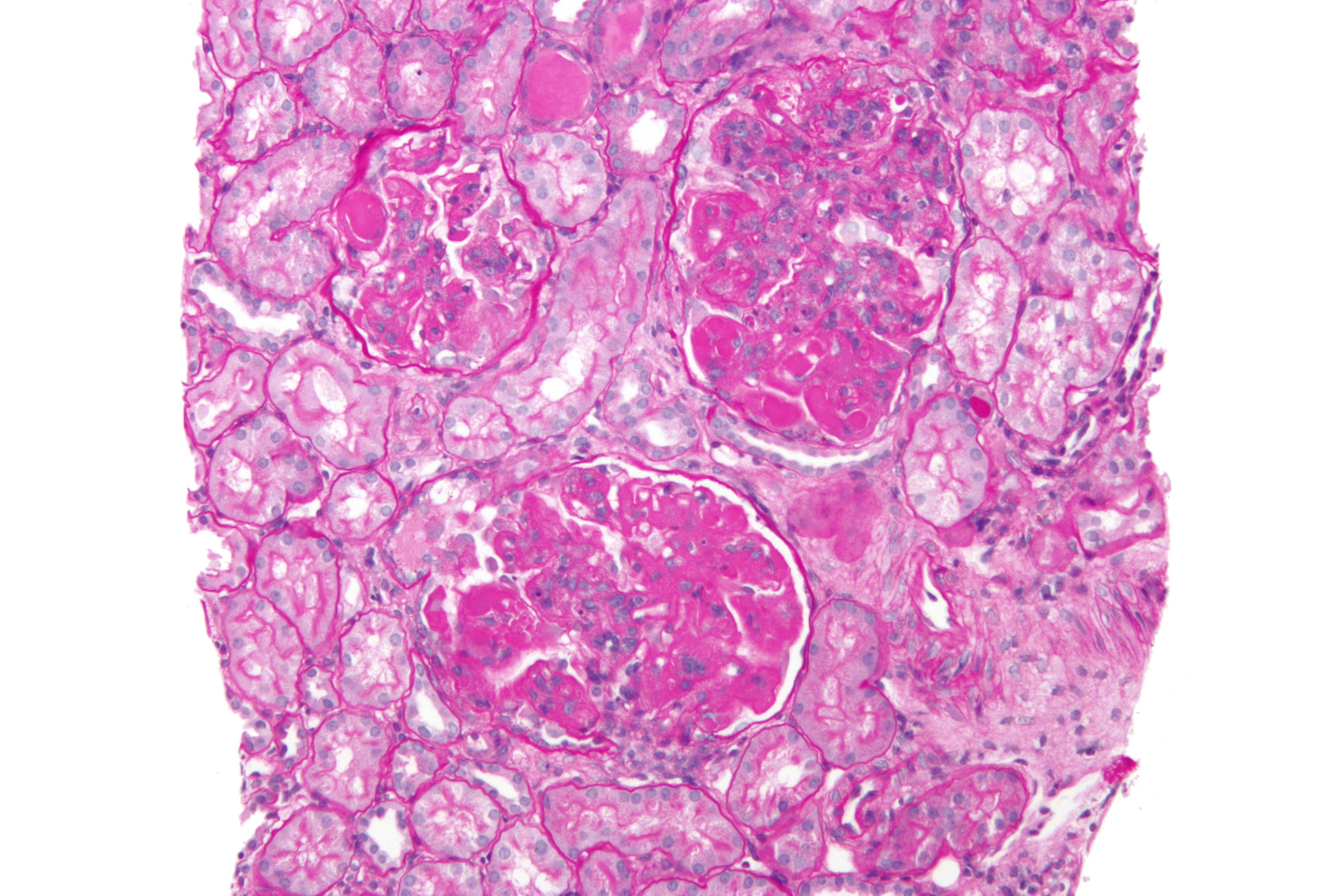 High magnification micrograph of diffuse proliferative lupus nephritis