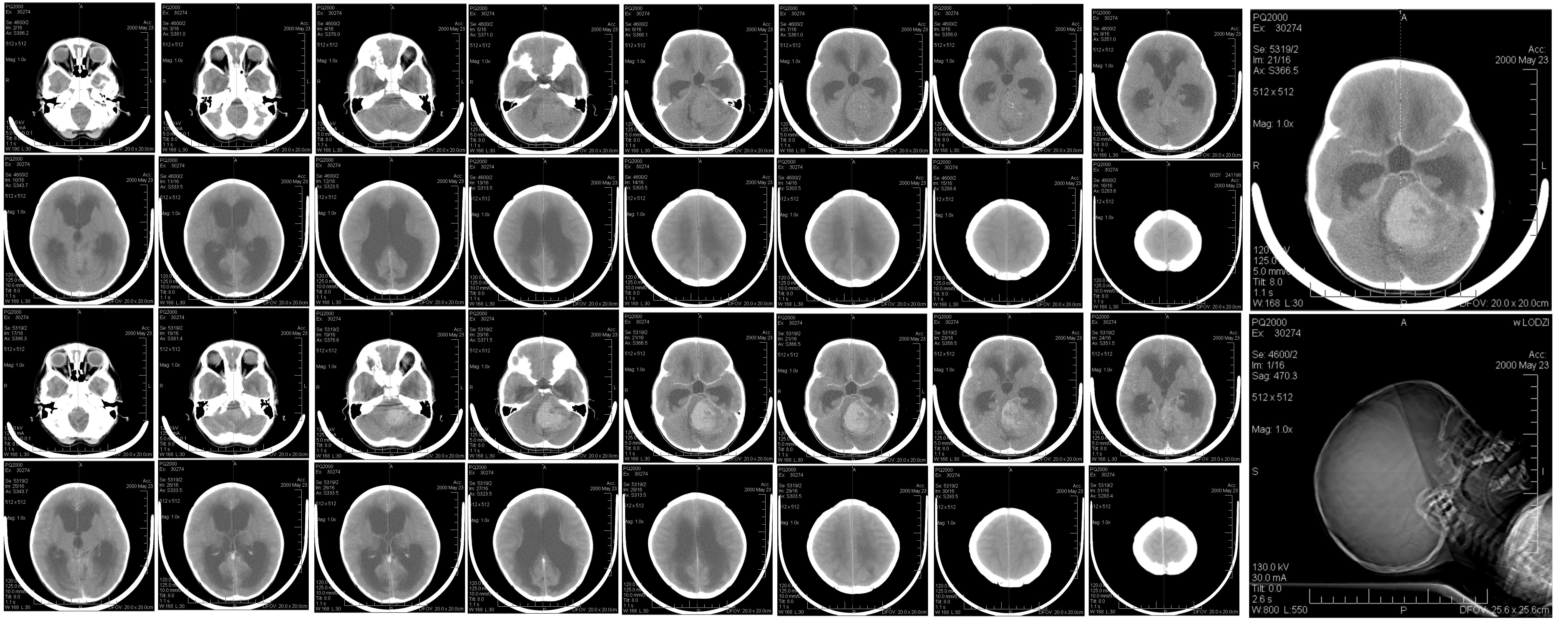 Scans of a pediatric brain tumor 