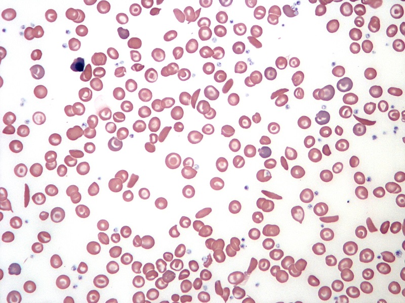 A blood smear showing many red blood cells some of them sickle-shaped