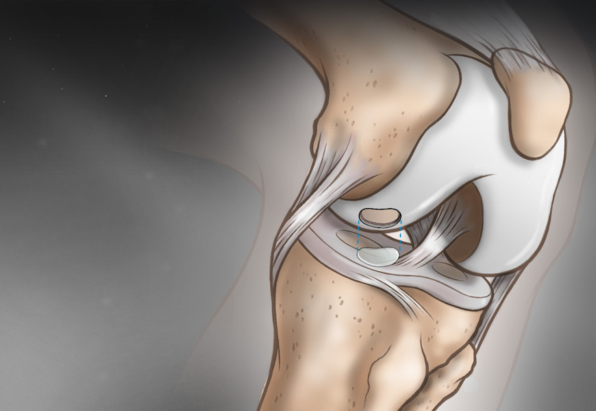 histogenics knee implant