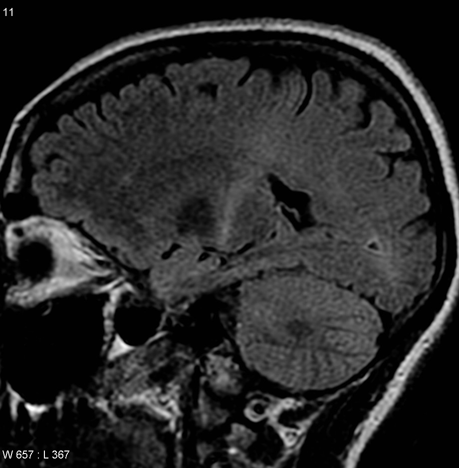 A MRI scan consistent with the clinical diagnosis of ALS