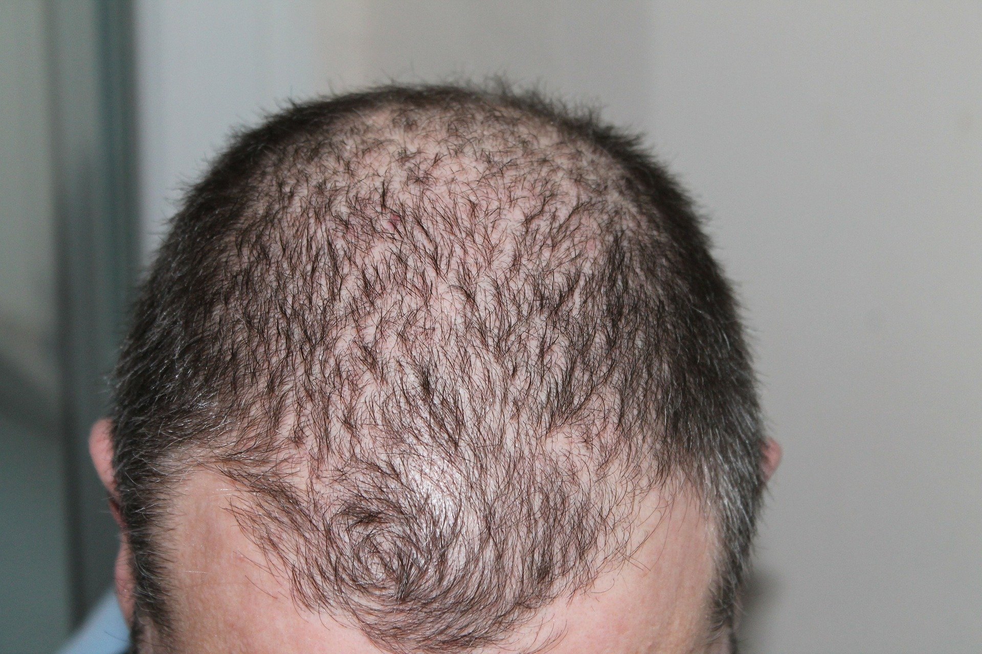 Replicel says hair loss therapy is safe, with glimmers of efficacy | Fierce  Biotech