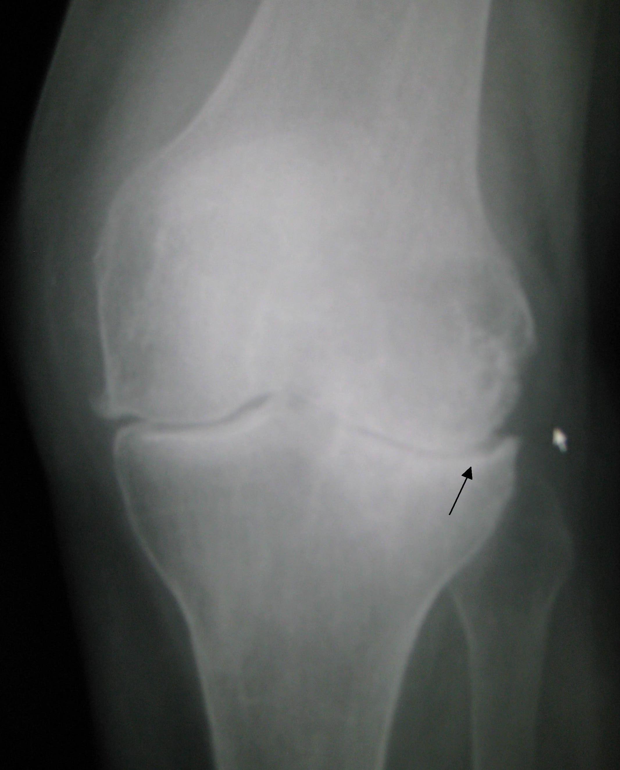 Osteoarthritis left knee
