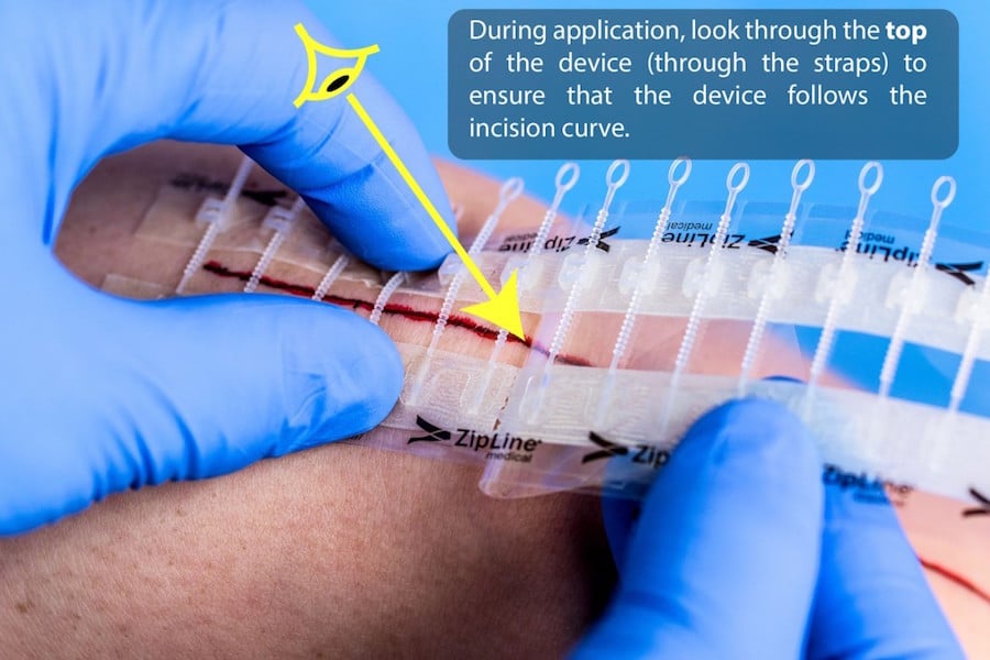 Doctor applying Zip surgical incision closure device to a wound