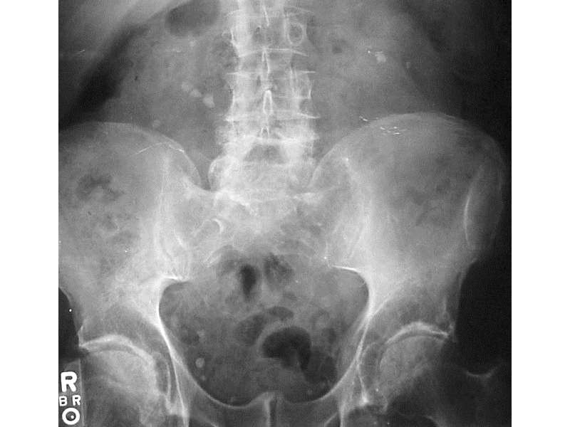 Kidney stones on X-ray