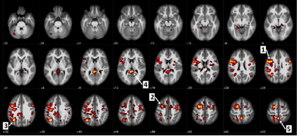Brain scans showing differences between patients with and without schizophrenia