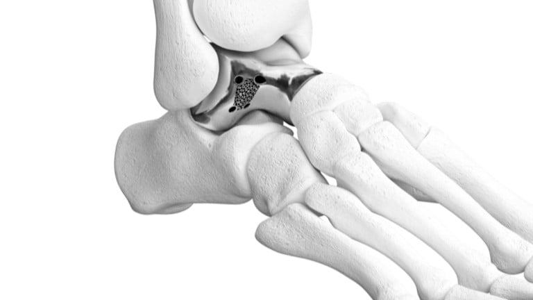 restor3d 3D-printed ankle implant