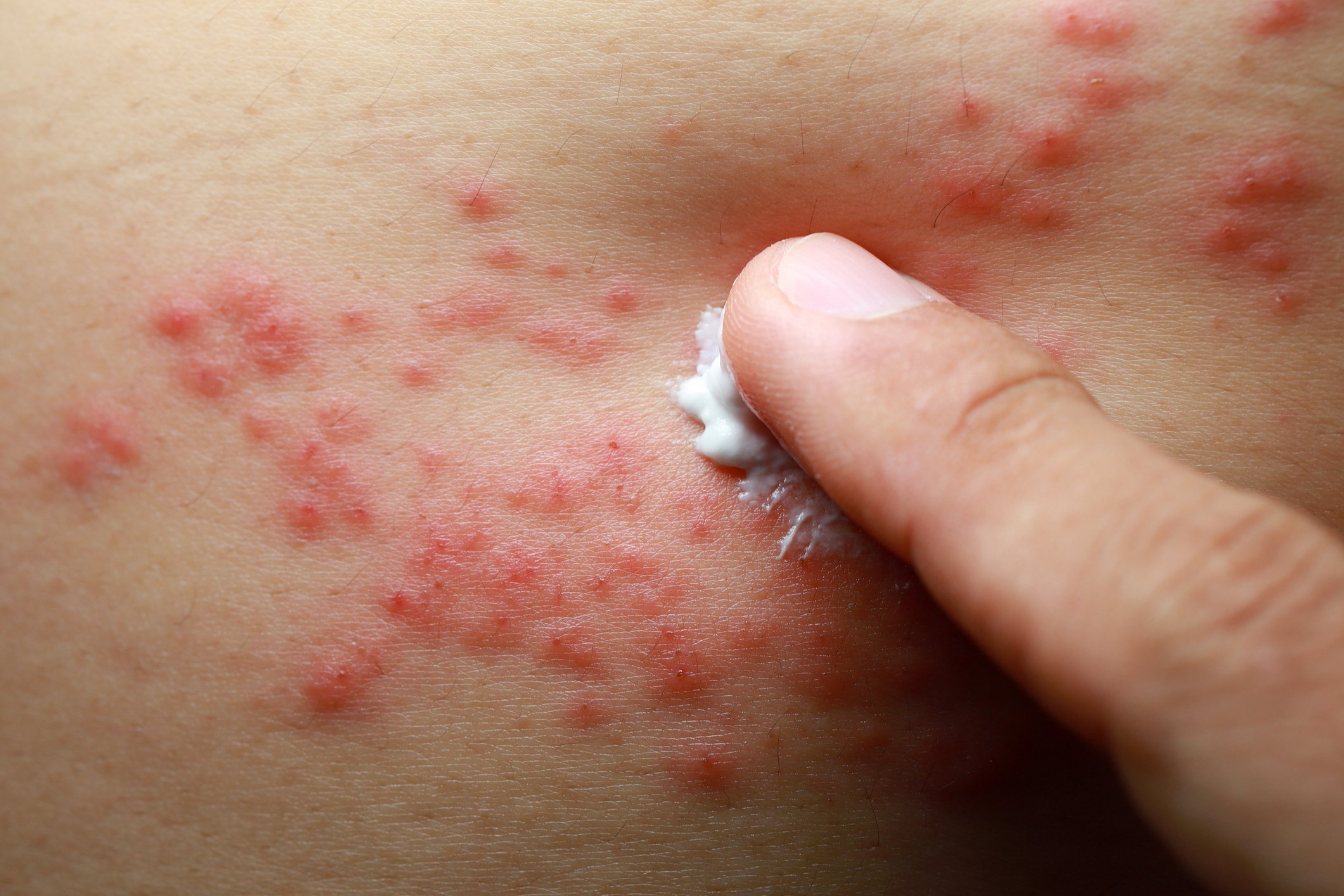 Ugle Fremhævet Tilsvarende NICE recommends eczema drugs from AbbVie, Pfizer and Leo Pharma