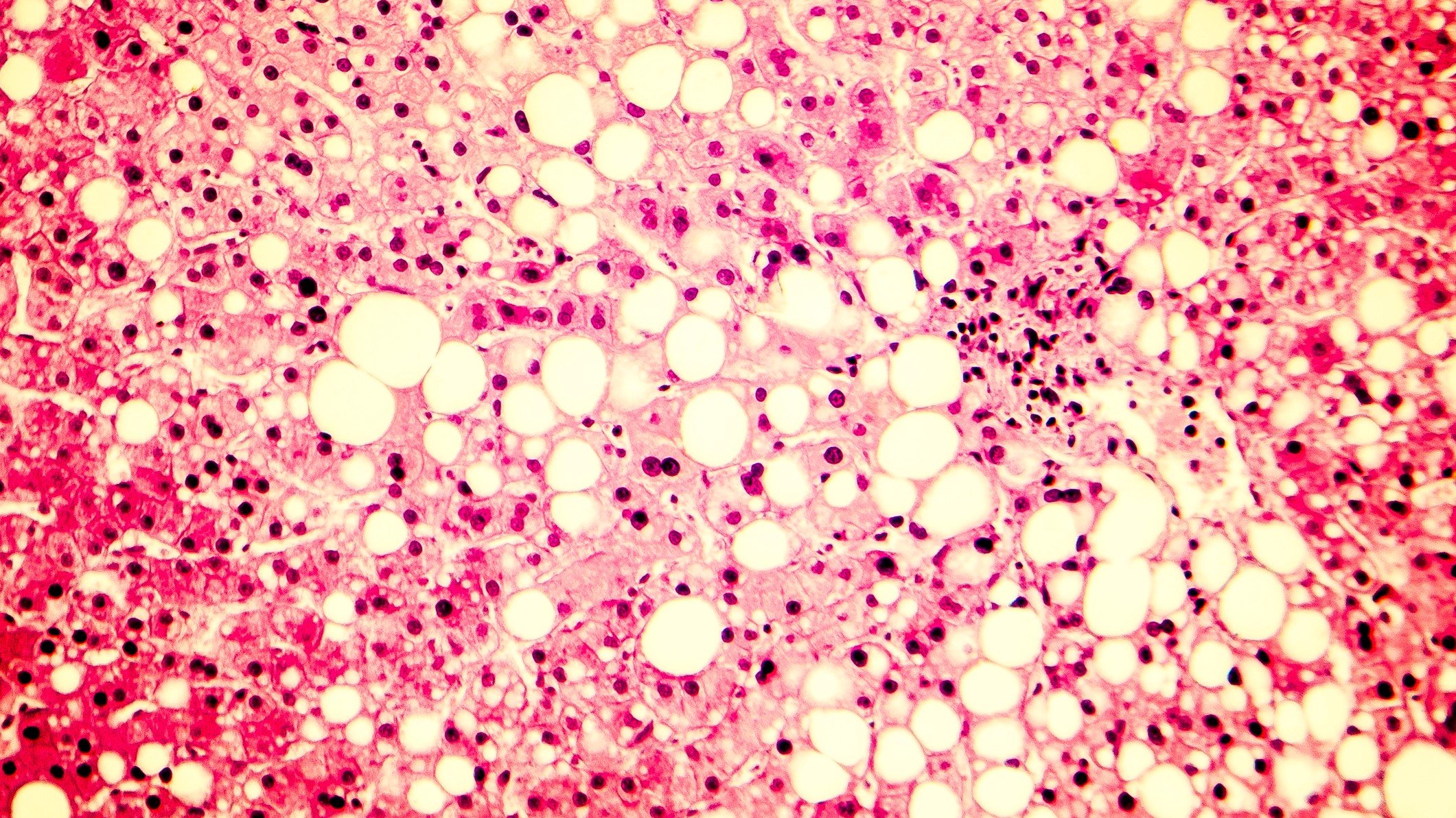 Fatty liver liver steatosis large vacuoles of triglyceride fat