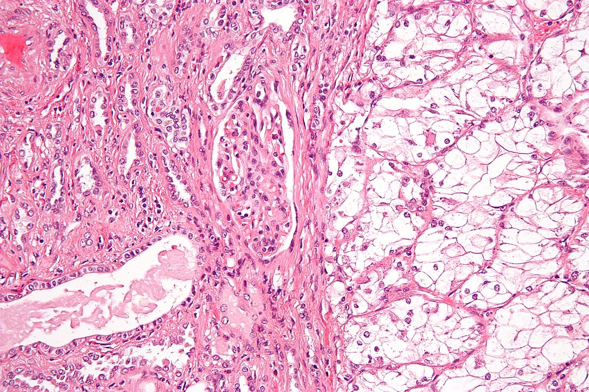 Renal cell carcinoma histology