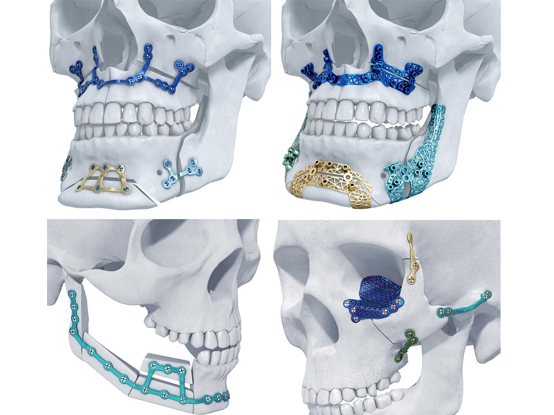 trumatch facial implants on skull models