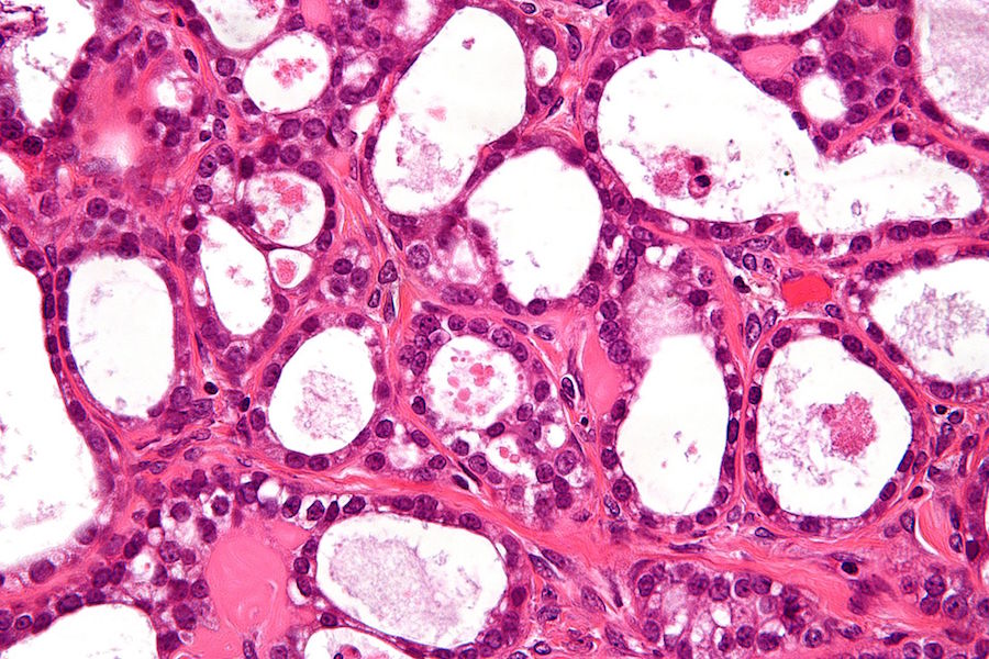 ovarian clear cell carcinoma