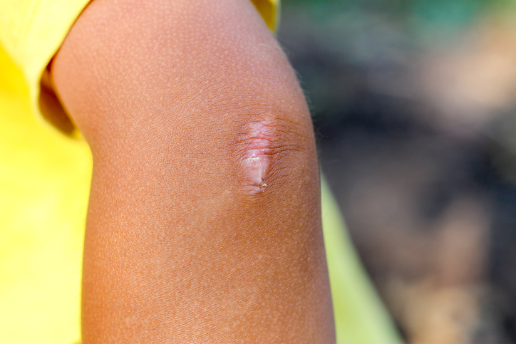 A childs elbow with a small hypertrophic scar 