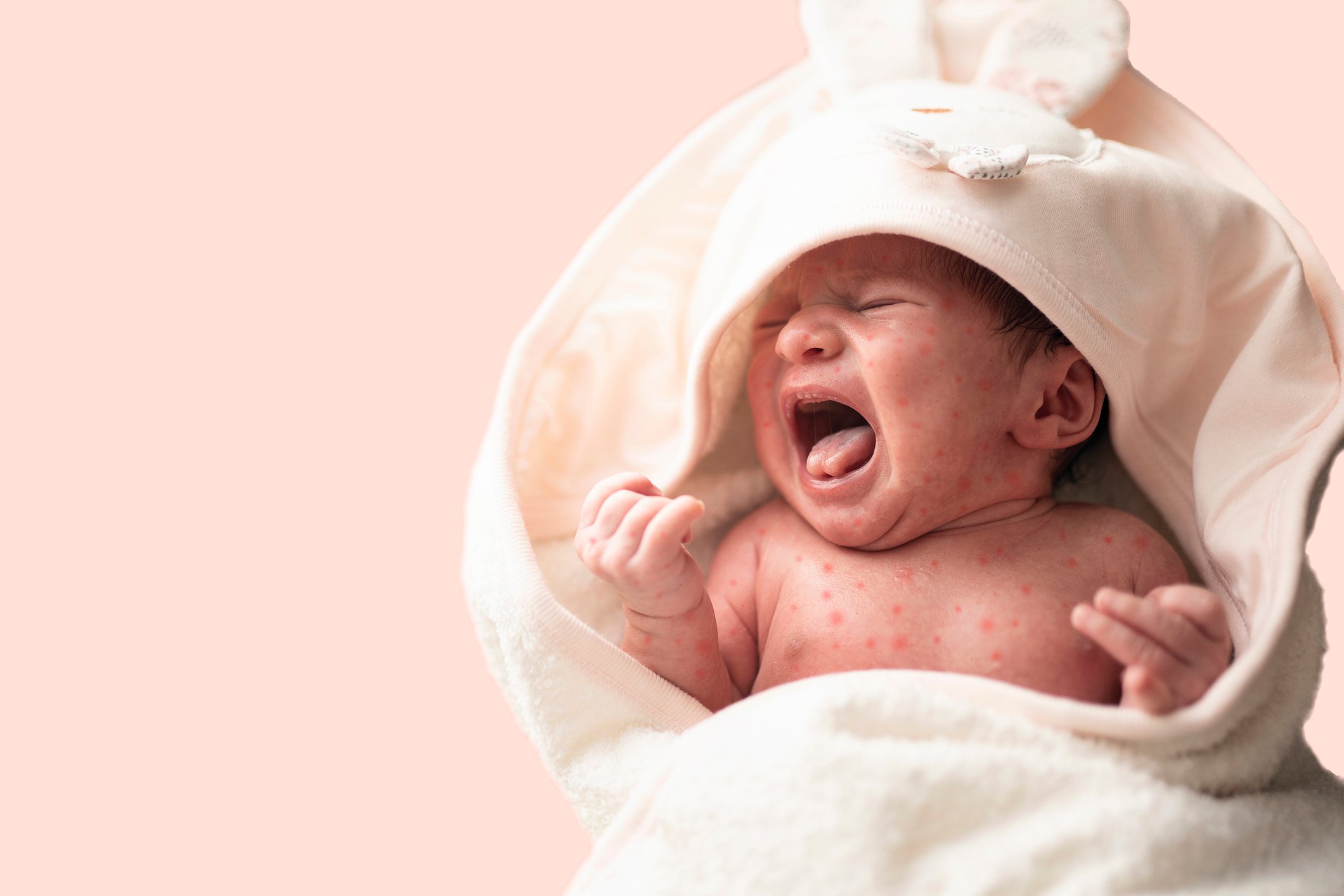 Crying baby with measles