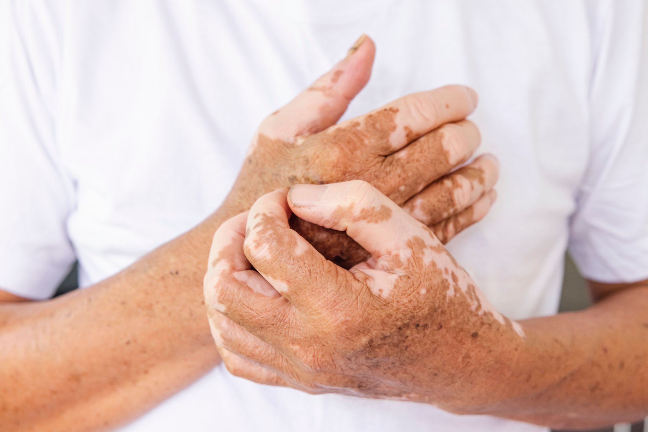 Vitiligo close-up hands