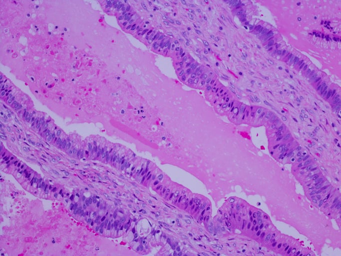 A histology stain of pancreatic ductal adenocarcinoma