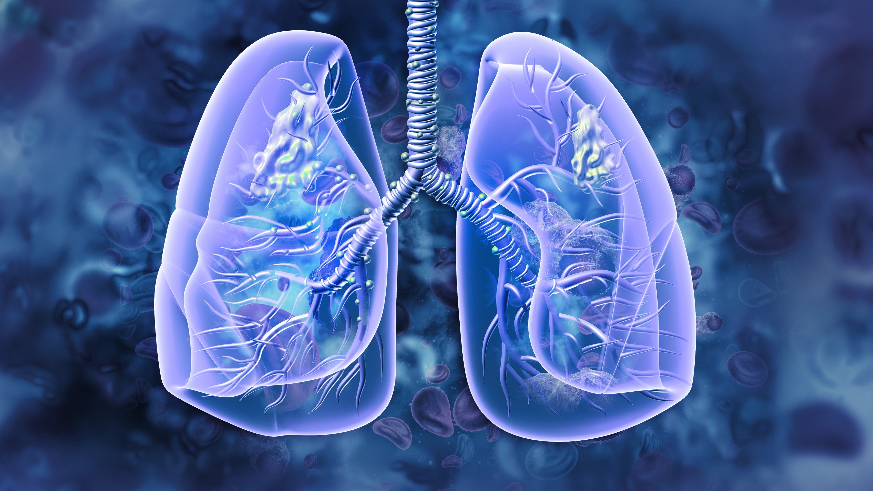 AI-based biomarker may predict lung cancer therapy response