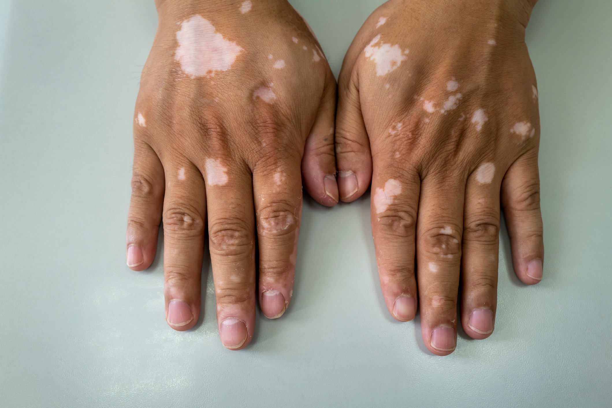photo of a pair of hands that show the skin condition vitiligo