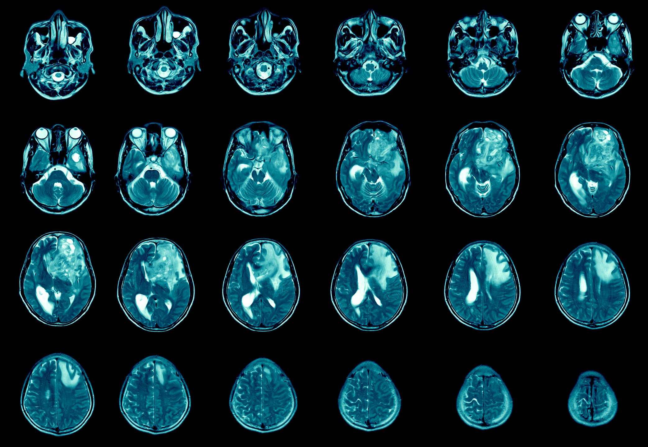 MRI scans depicting glioblastoma with poorly-defined margins and surrounding edema in the left frontal lobe