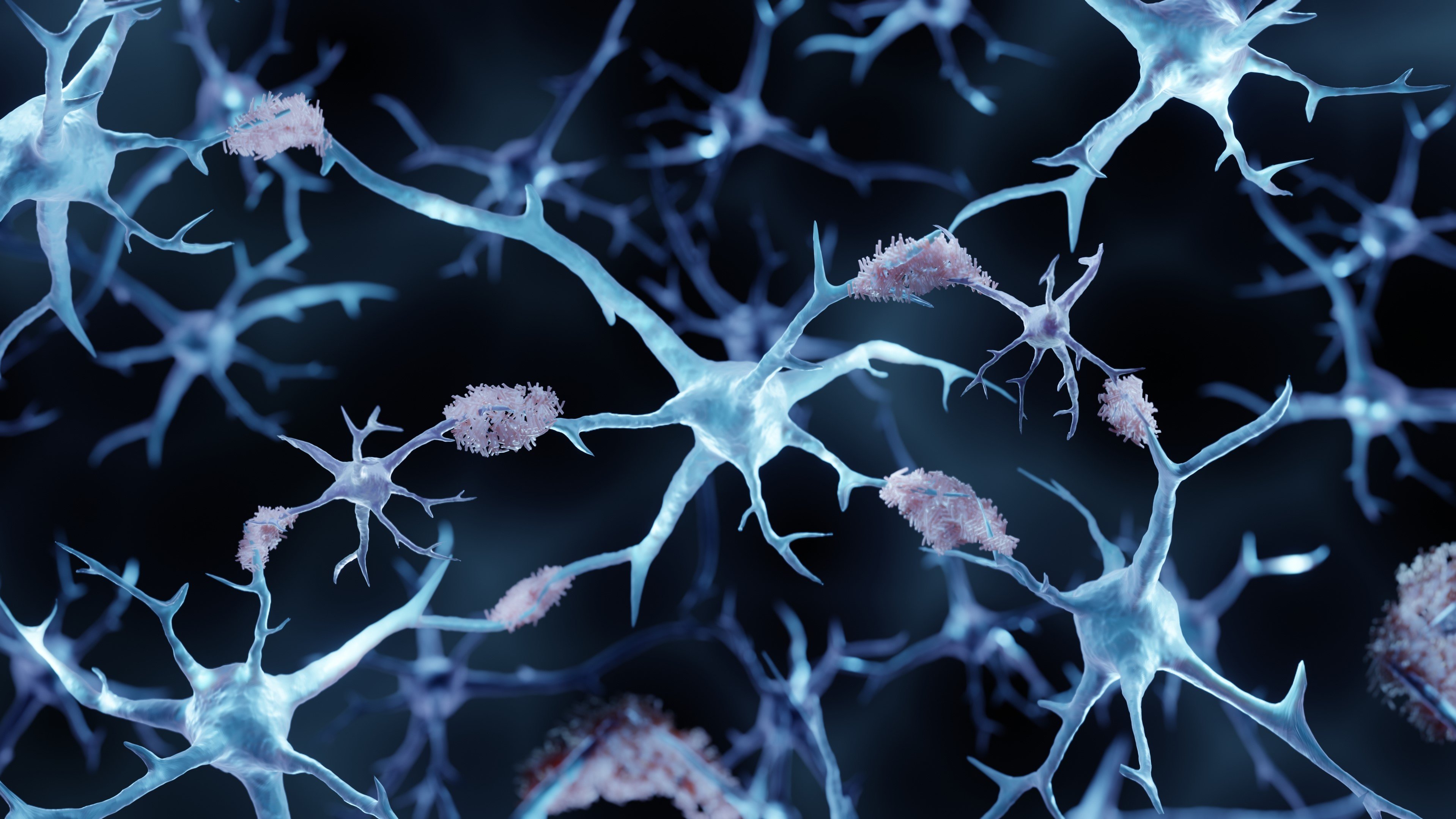 amyloid plaque alzheimers brain