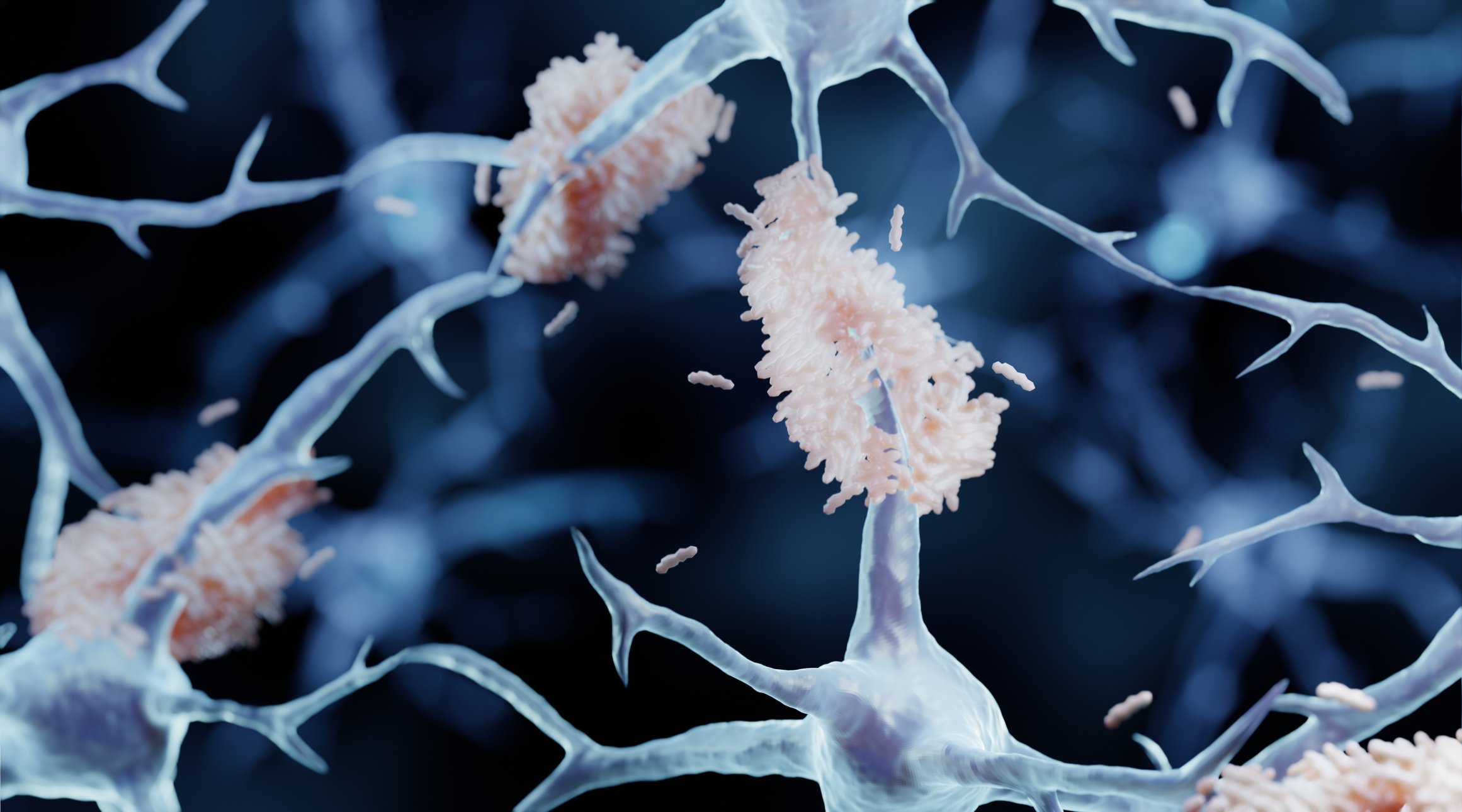 An artists impression of amyloid plaques accumulating on neurons The neurons are translucent white on a blue background wi