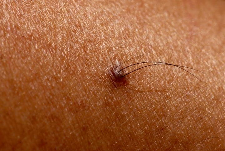 An image of a mole on human skin with hair sticking out of it