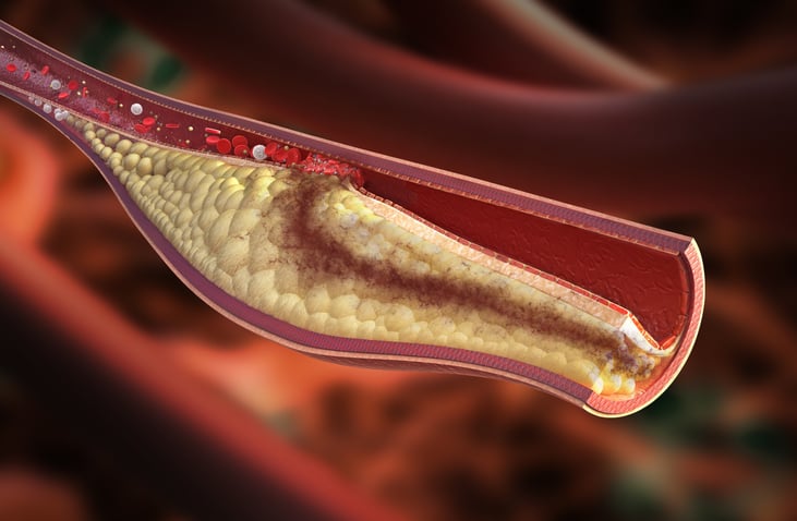 An artists rendition of plaque buildup in an artery The plaque is a yellow fatty substance that is nearly blocking off red