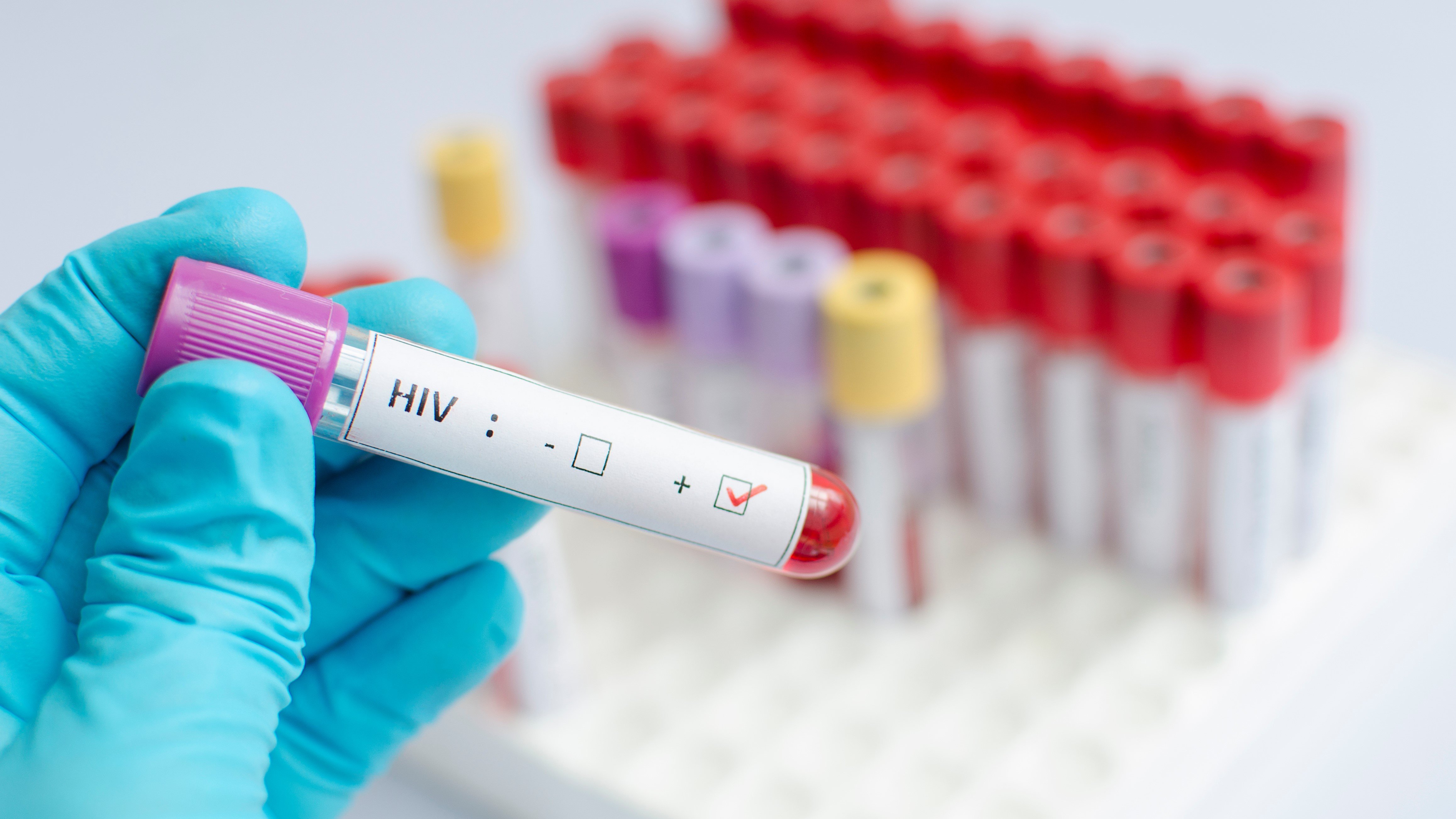 HIV blood virus AIDS vials