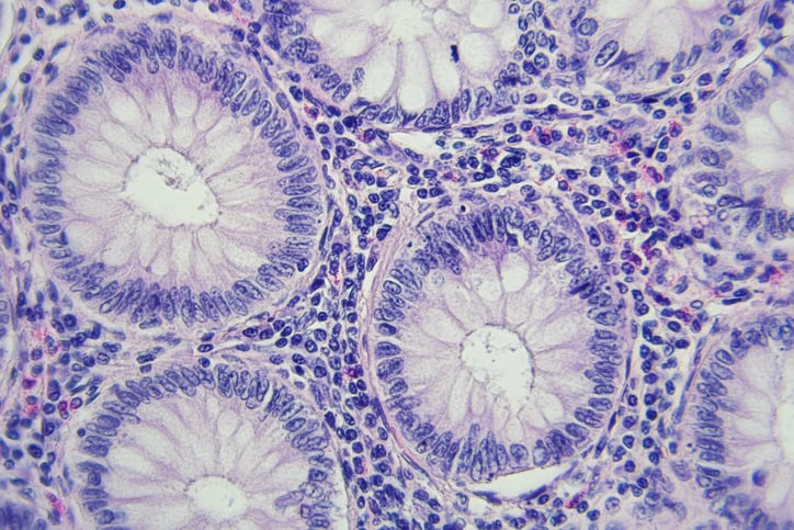Colon cancer cells magnified 400x under a microscope The cells are purple and take on spherical shapes around a round center
