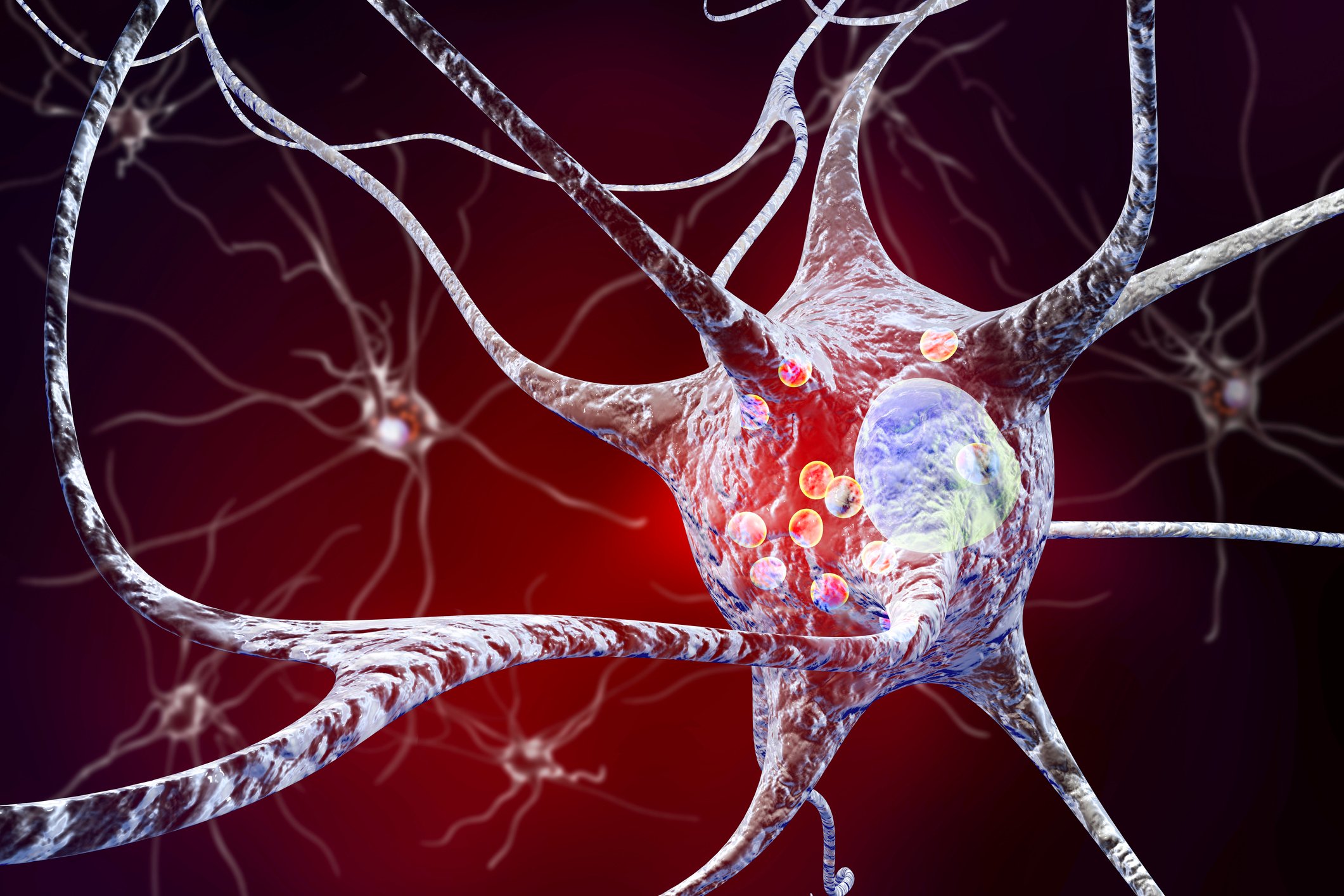 visual of neurons under Parkinsons disease