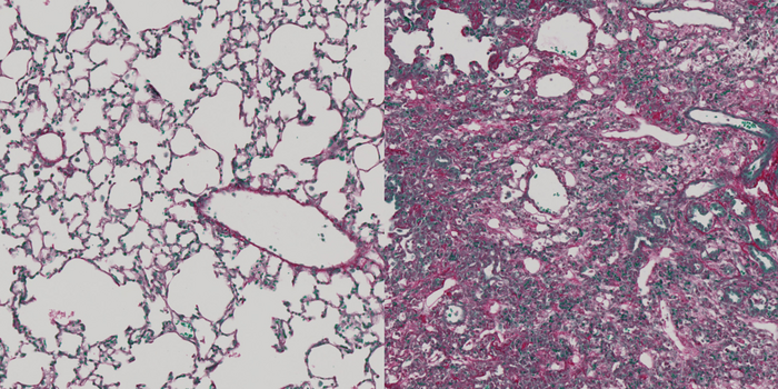 Health lung tissue on the left has many open air-filled alveoli Fibrotic lung tissue on the right is dense with connect