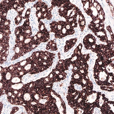 Positive Case of lung tissue stained for ALK