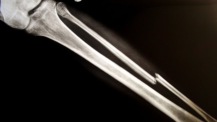 broken bone fracture break x ray skeleton