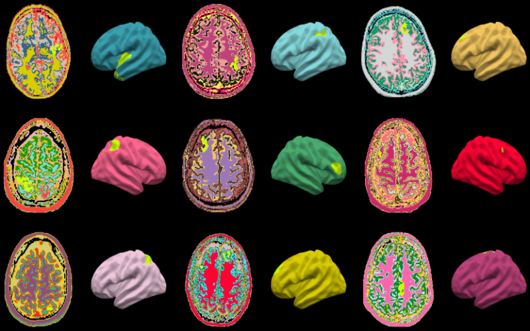 epilepsy AI MRI
