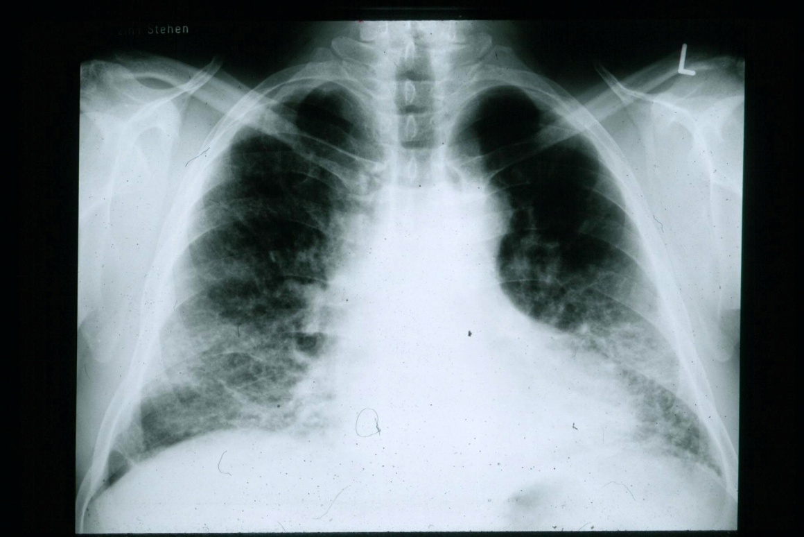  A chest radiograph of a patient with IPF