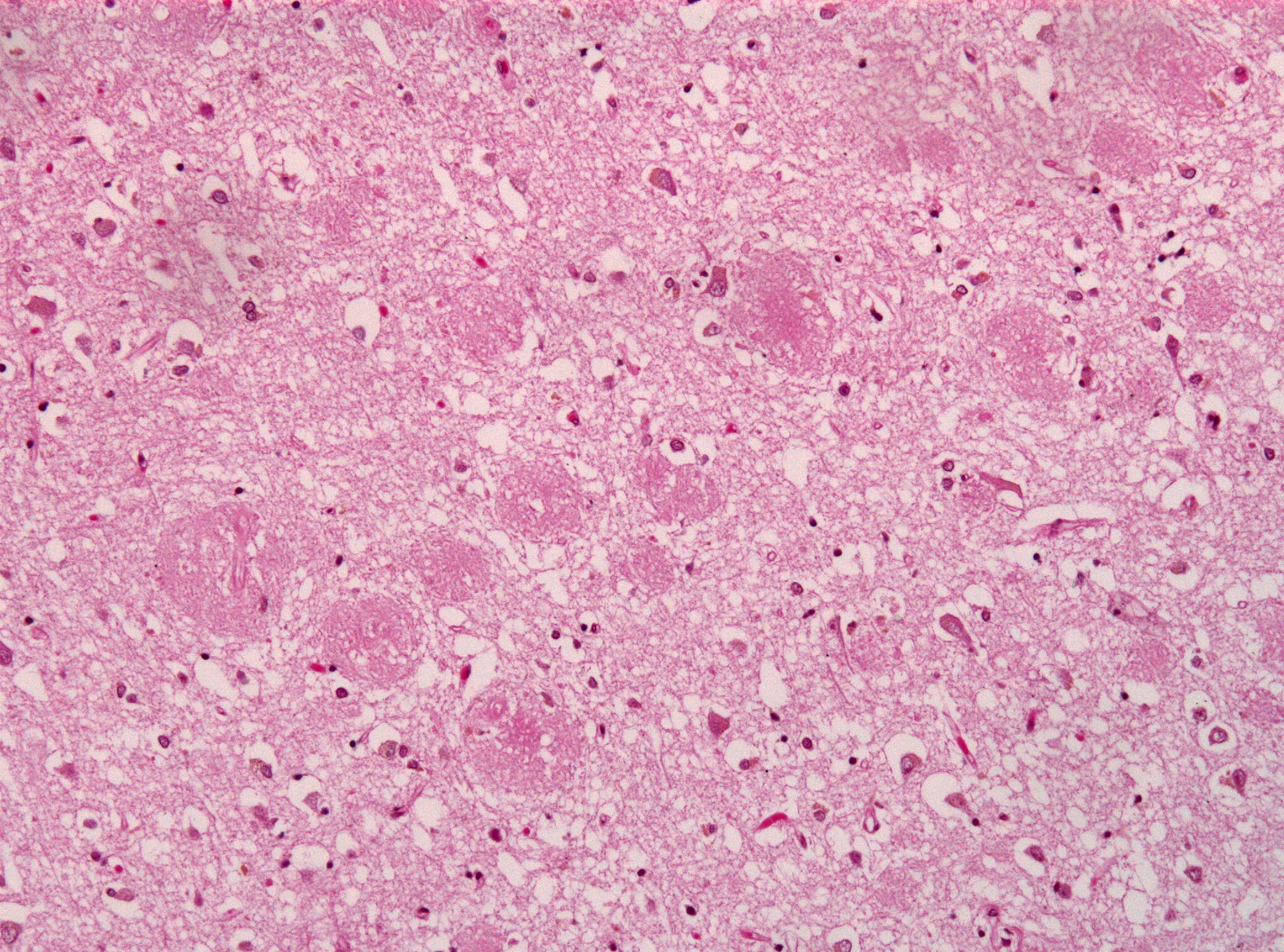 Amyloid plaques in Alzheimers disease