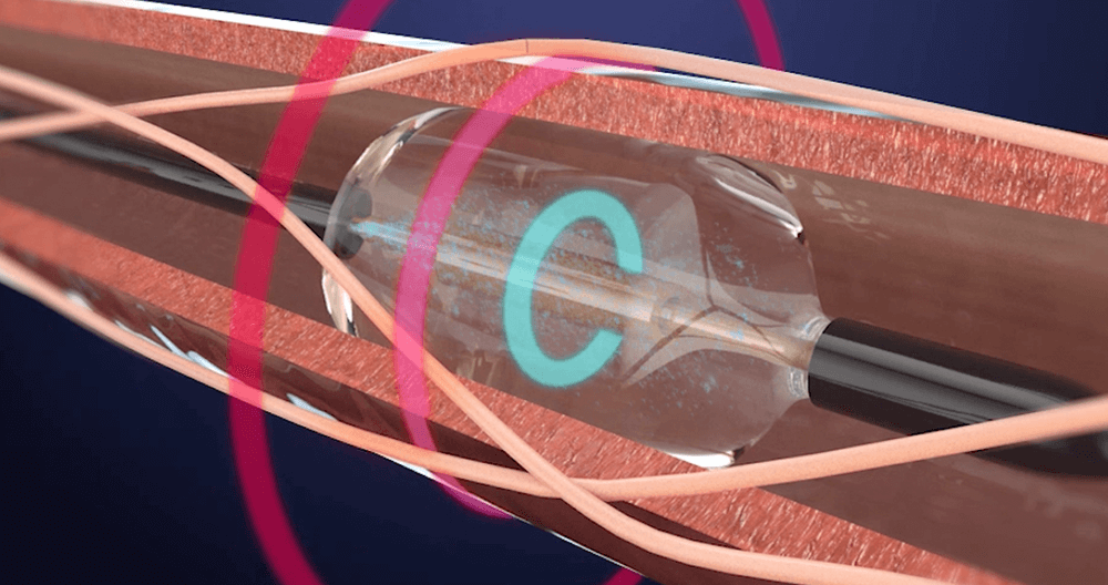 An illustration of ReCors renal denervation catheter