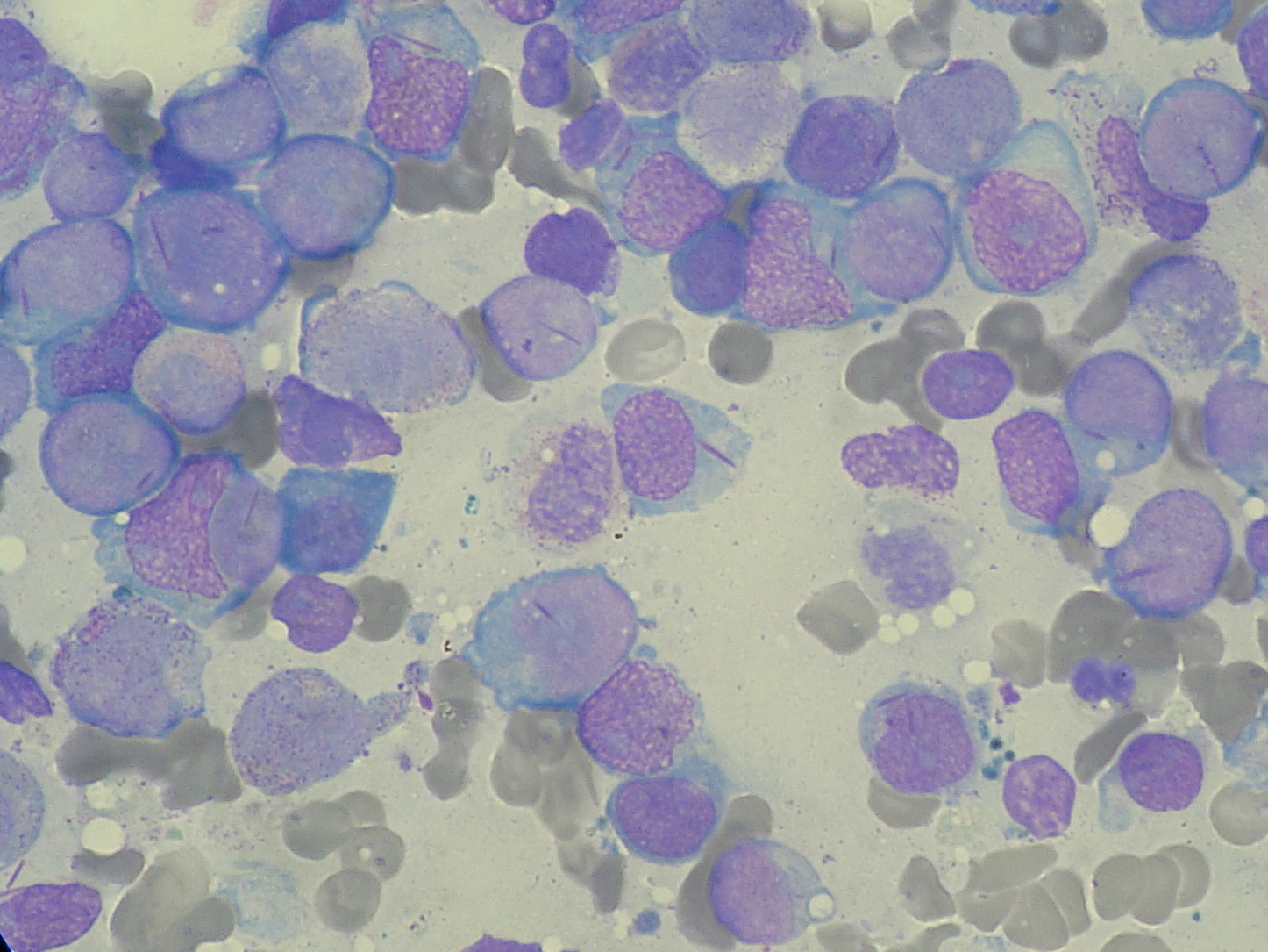 Myeloblasts with Auer rods seen in acute myeloid leukemia