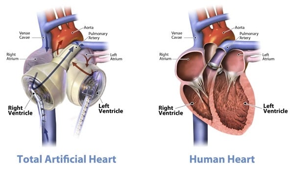 SynCardia artificial heart